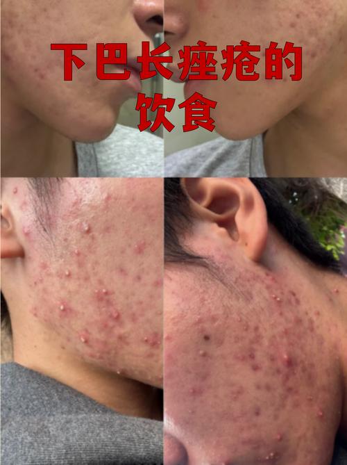 脸上长榨菜能自愈吗