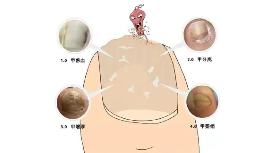 灰指甲拖久了会怎么样
