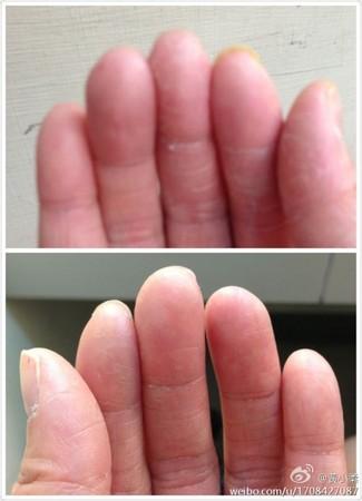 手指纹消失了该怎么恢复原样