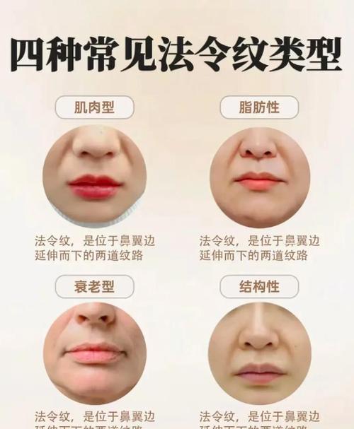 长了法令纹还能消除吗