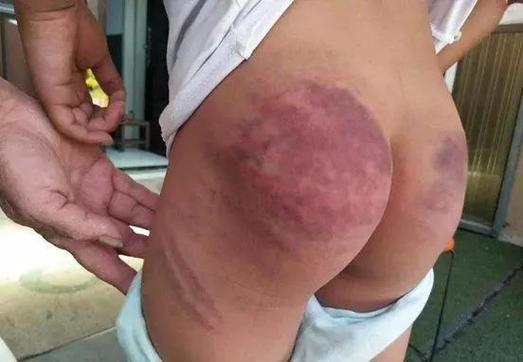 打完屁股一直疼