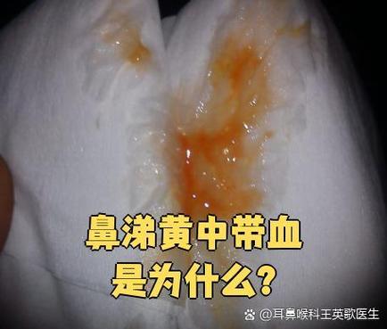 鼻子有黄浓鼻涕带血缩略图