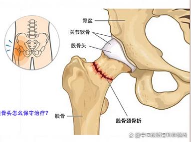 股骨头保守治疗都有哪些方法