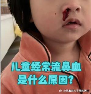 儿童左鼻孔经常流鼻血