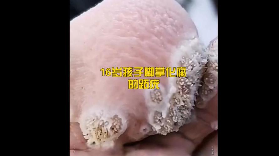 跖疣拔出根的样子