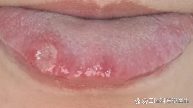 舌中间痛什么原因女性