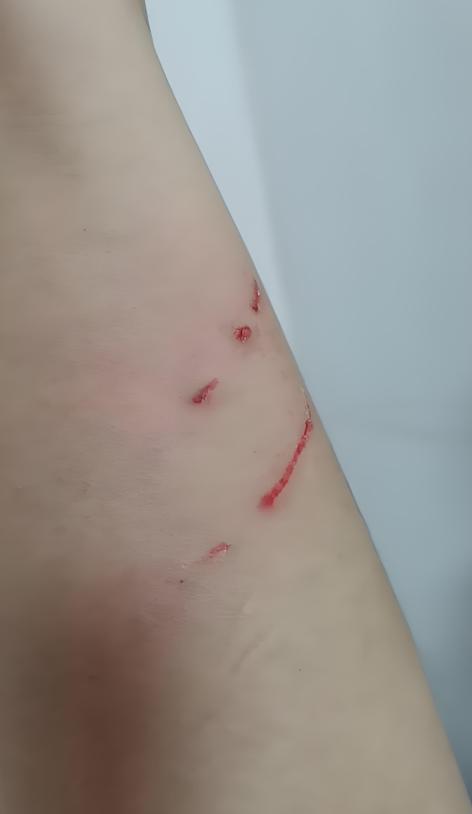 扎个口子会得狂犬病吗