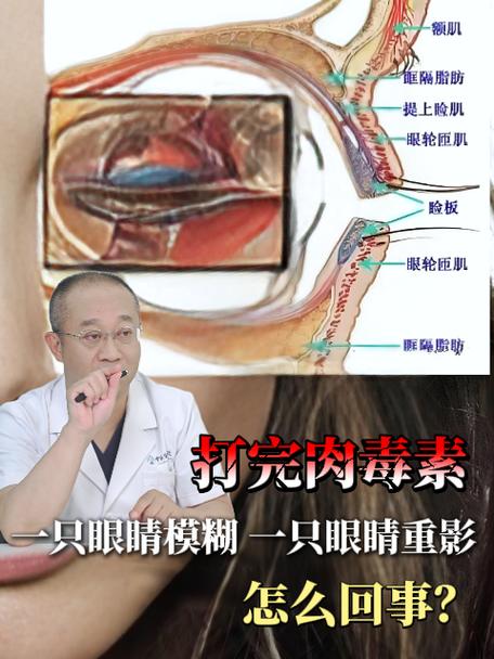 眼重影模糊是什么原因引起的