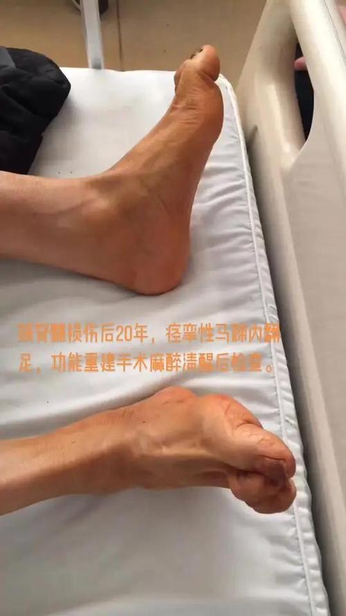 手术麻醉后四肢麻木