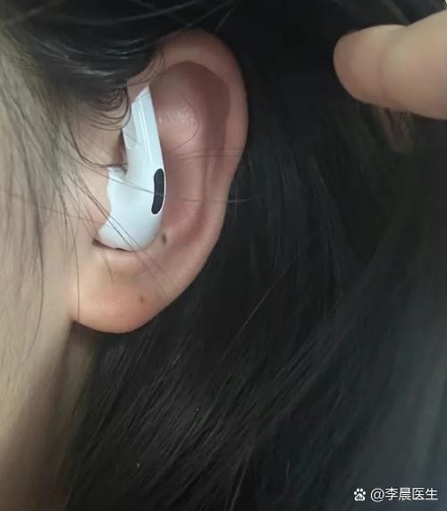 戴入耳式耳机耳朵痒
