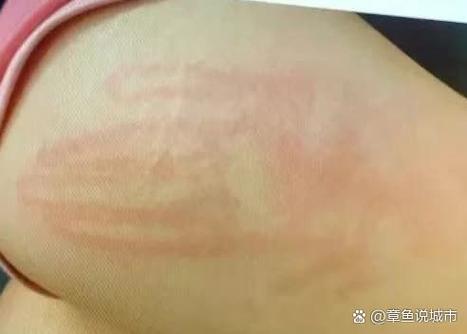 巴掌红肿臂瓣颤抖