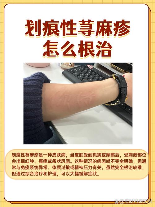 划痕症荨麻疹怎么治
