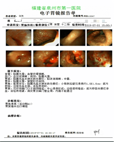 胃癌没有扩散是晚期吗