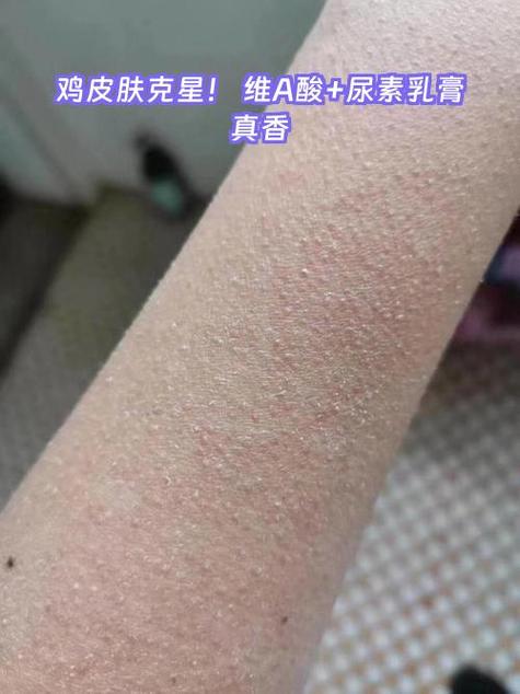 什么是鸡皮肤图片