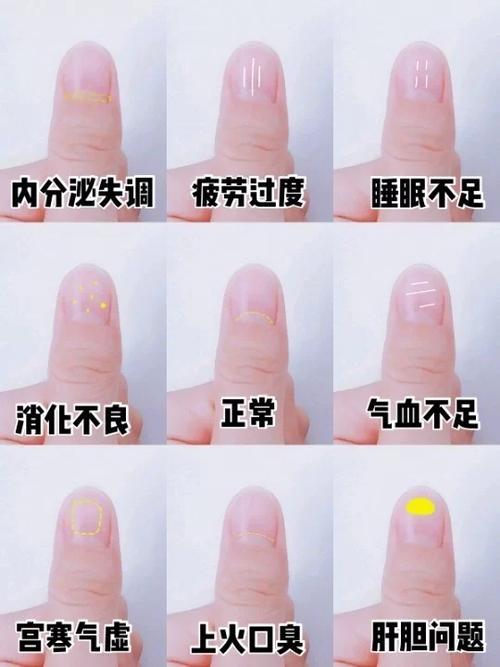 指甲有竖纹怎么回事截图