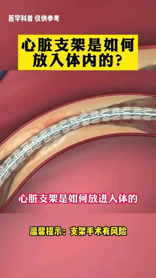 心脏支架能重叠吗