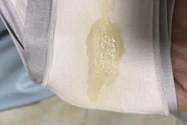 内裤上出现白色粘稠物是什么原因