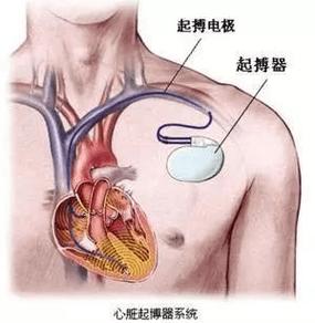 人一旦装了起搏器就很难恢复吗