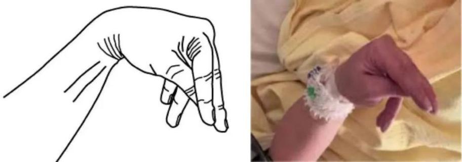 手抽搐是怎么回事