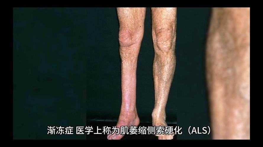 als是什么疾病