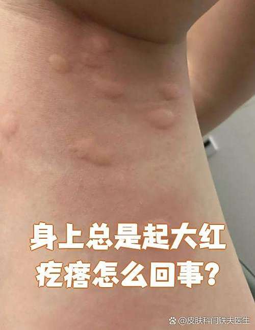 我身上起了红疙瘩特痒的