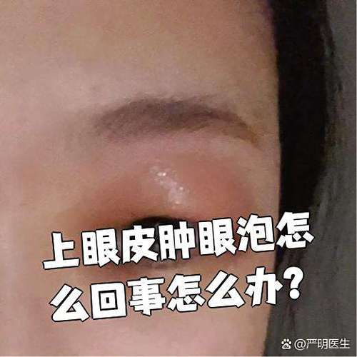 上眼皮泡泡眼怎么消除