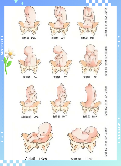 怀孕横位是怎么造成的