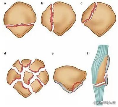 余钉合因点