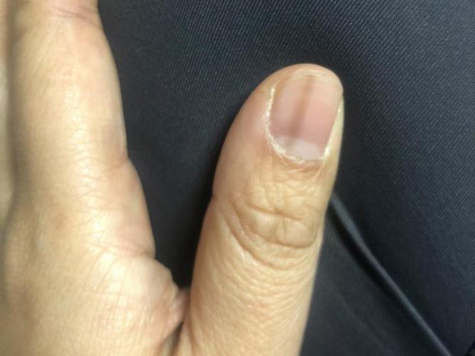 甲母痣早期图片