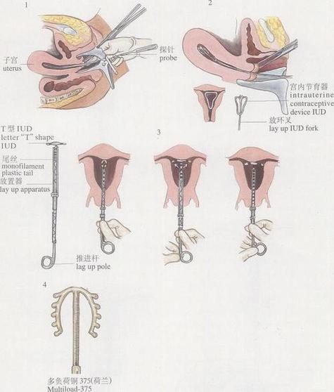 46岁不想带环怎么避孕