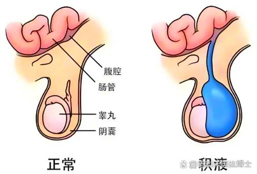 睾丸鞘膜积液是什么病截图