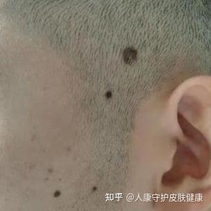 去除老年斑最佳方法