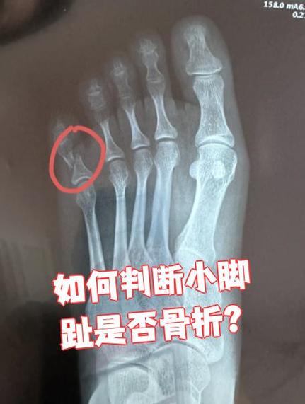 怎么确定脚趾头骨折了