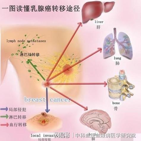 哪几种癌症易转移