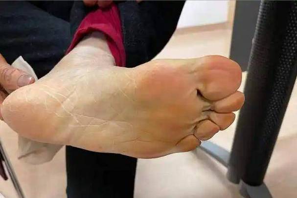 为什么脚板上有那么多小洞