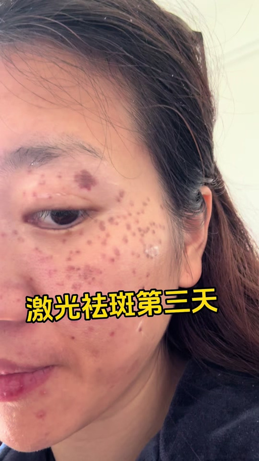 激光祛斑视频图标
