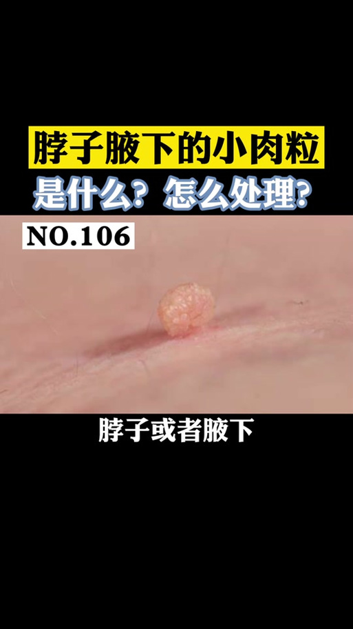 腋下长小肉揪揪是怎么回事