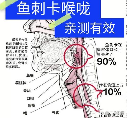 卡鱼刺的正确处理方法