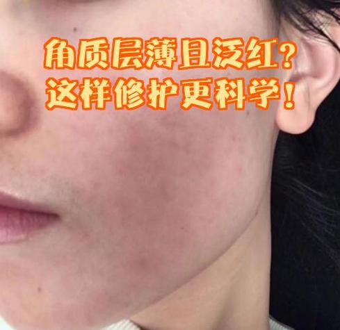 皮肤角质层薄脸容易红怎么办