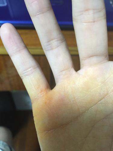 仓鼠咬了一下没破皮