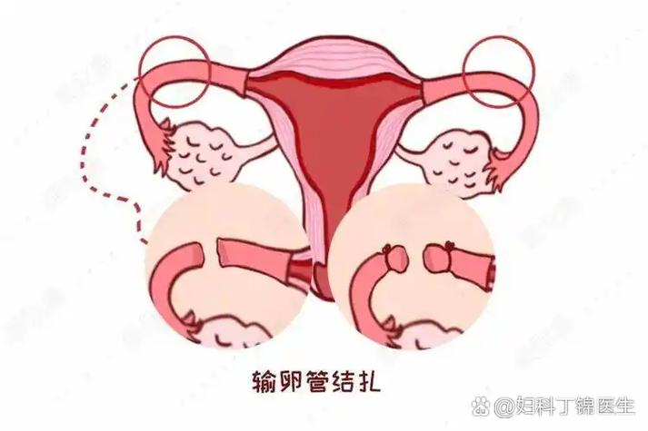 输卵管近端堵塞有救吗