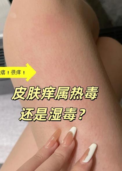 热毒和湿毒的区别图片