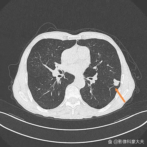 增强扫描不均匀明显强化说明什么