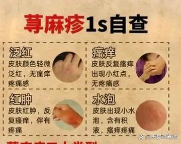 荨麻疹拖久了会怎么样
