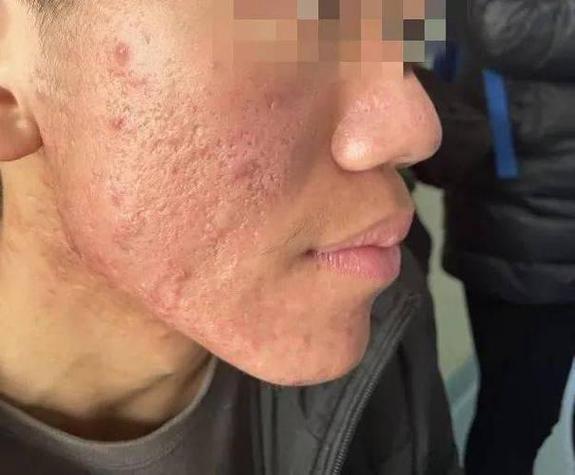 挤痘痘留下的硬疙瘩会消吗