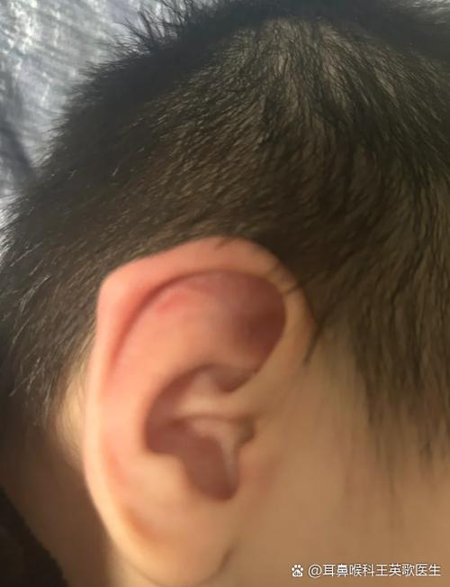 耳朵硬截图