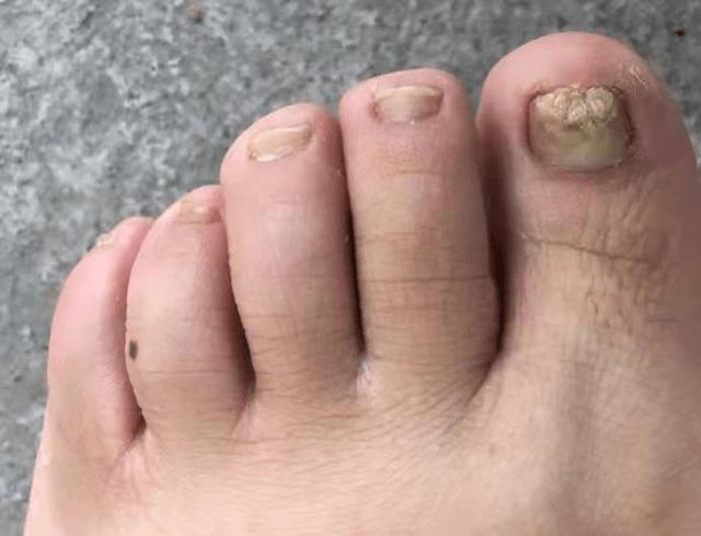 德国sos灰指甲笔效果好吗