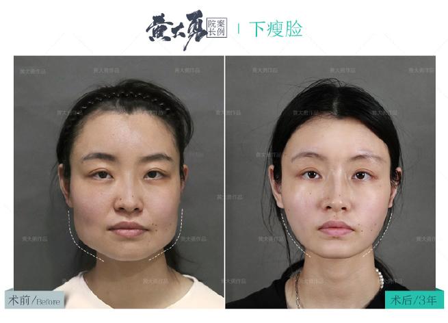 大小脸怎么改善