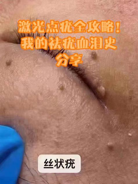 激光点疣多少费用