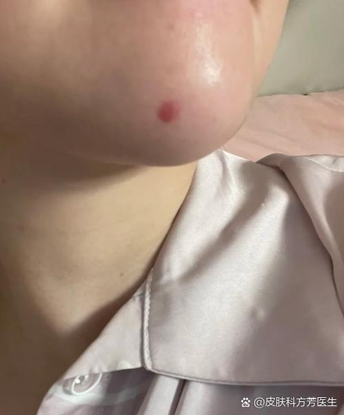 红印子多久才能恢复截图